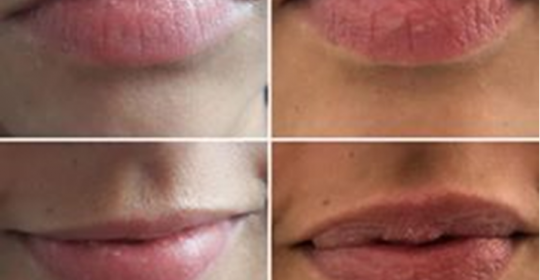 Preenchimento de lábios – Ácido Hialurónico