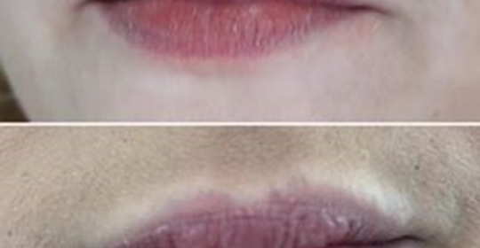 Enchimento de lábios – Ácido Hialurónico