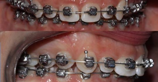 Ortodontia – Damon System