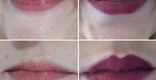 Aumento de lábios – Ácido Hialurónico