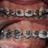 Ortodontia – Damon System